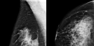 Estudo mostra que sistema do Google pode melhorar detecção de câncer de mama